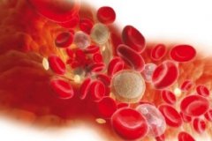 阵发性睡眠性血红蛋白尿如何进行输血治疗